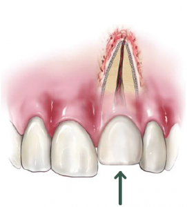 Răng bị lún vào do chấn thương